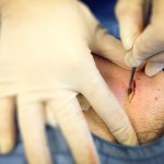 Chirurgia dermatologica