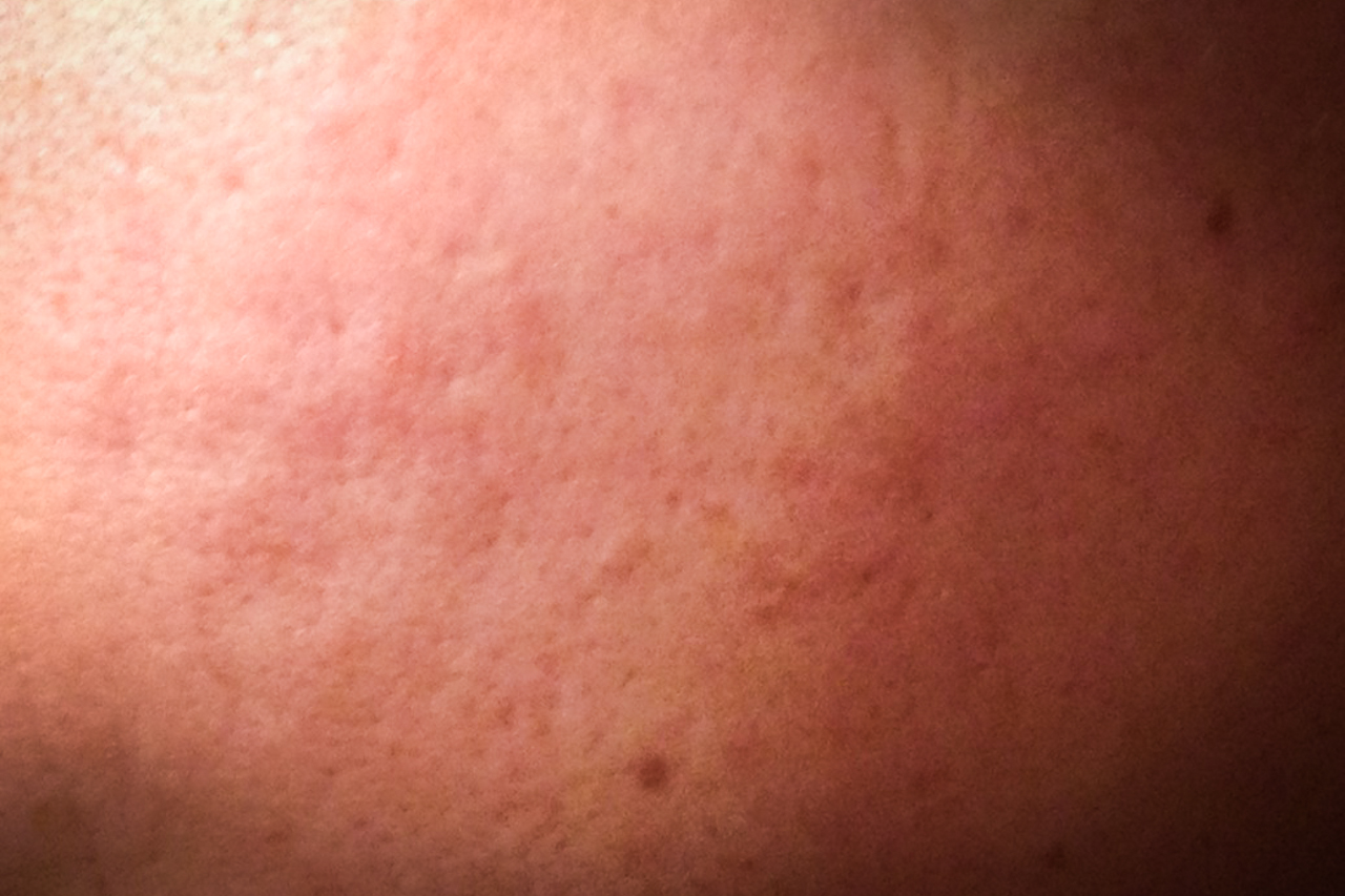 Flogosi Cronica Granulomatosa Gigantocellulare Del Derma