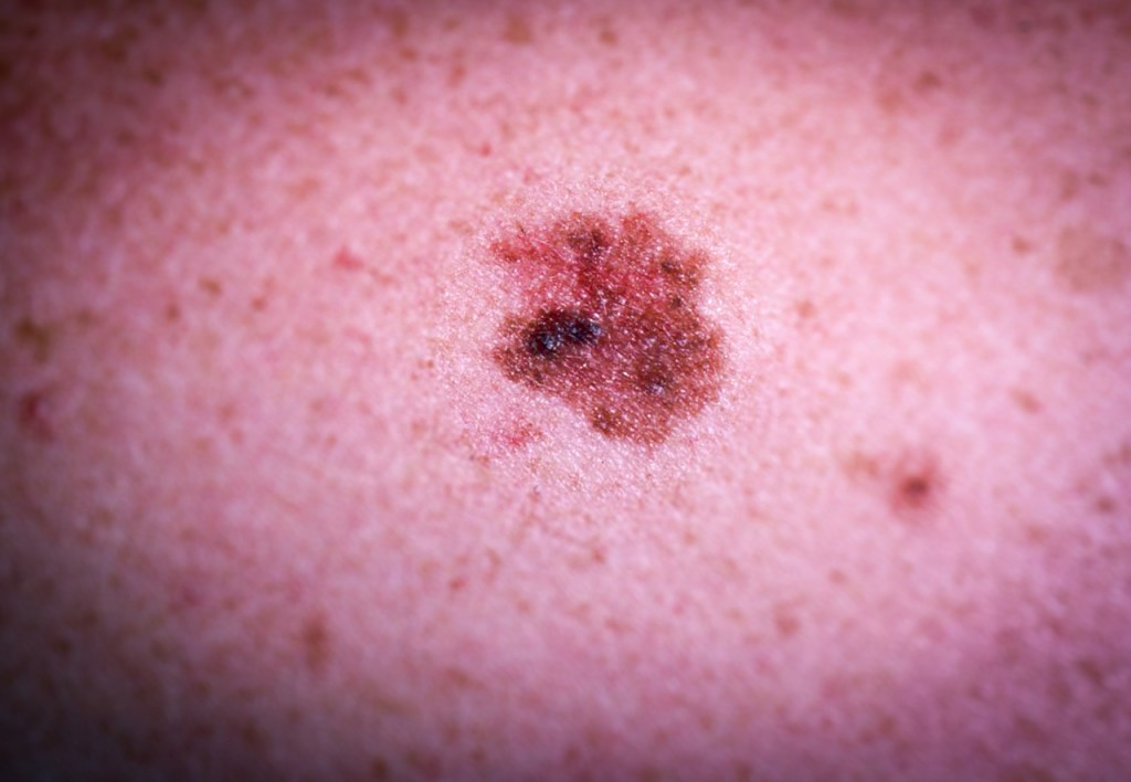 Melanoma