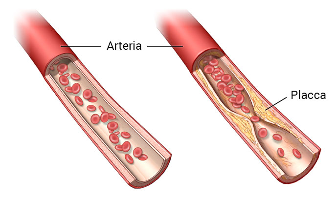 Aterosclerosi e arteriopatia - Stenosi ad un'arteria